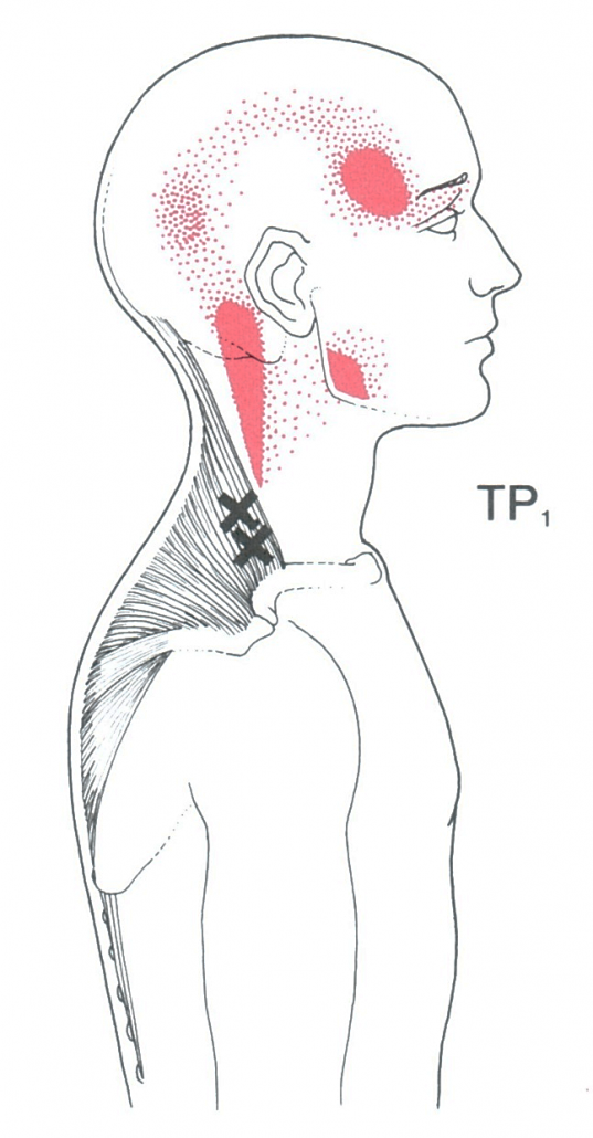 Chiropractic Care treats headaches