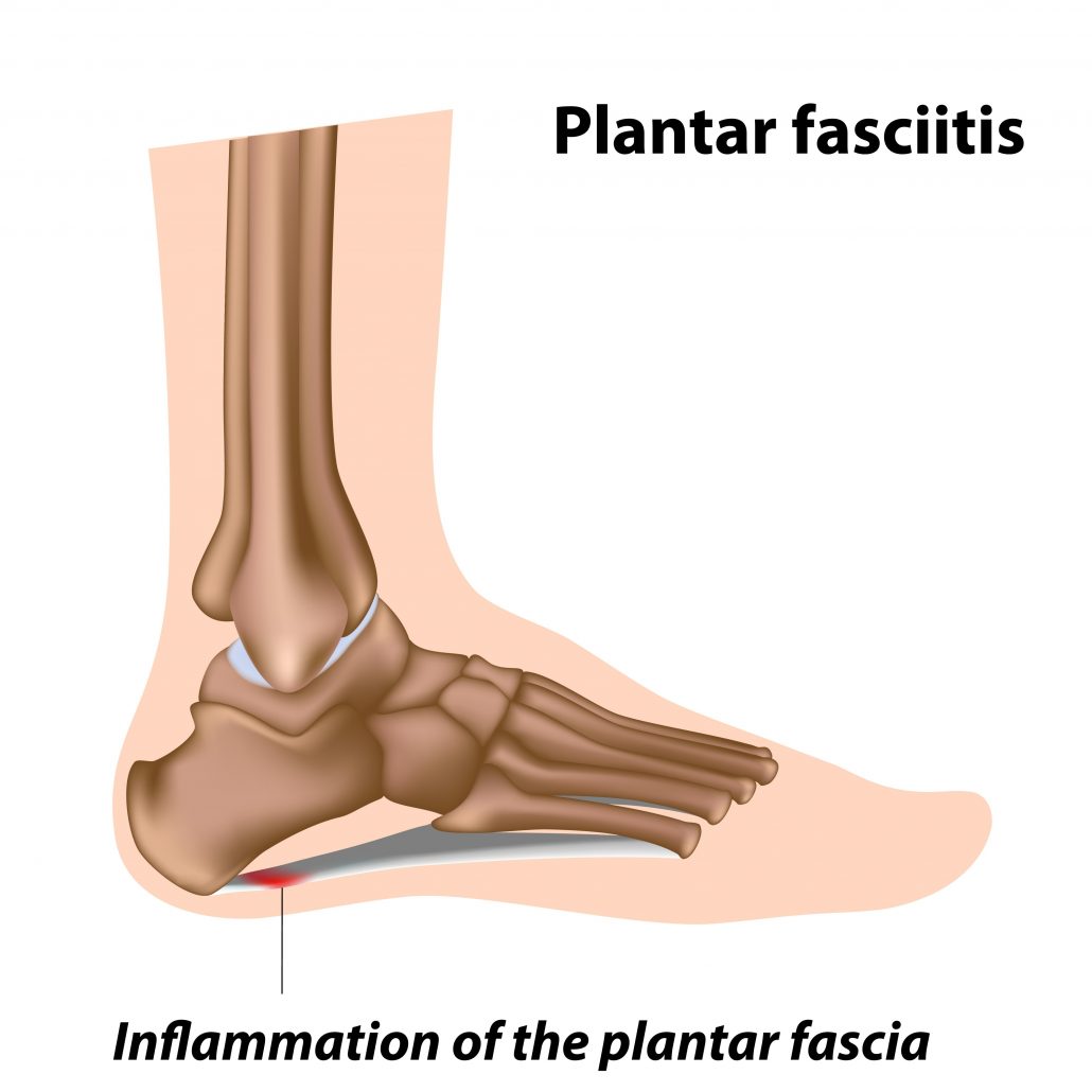 Treatment for Plantar Fasciitis San Diego