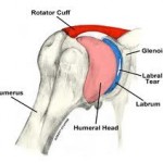 Glabrum - Picture of Shoulder