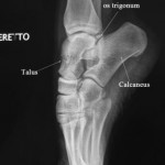 Lateral Demipointe Compressed - Xray of Ankle