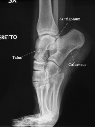 Lateral Demipointe Compressed - Xray of Ankle