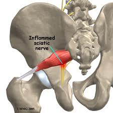 Piriformis Syndrome