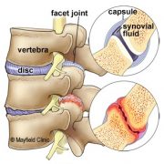 Facet joint syndrome and pain