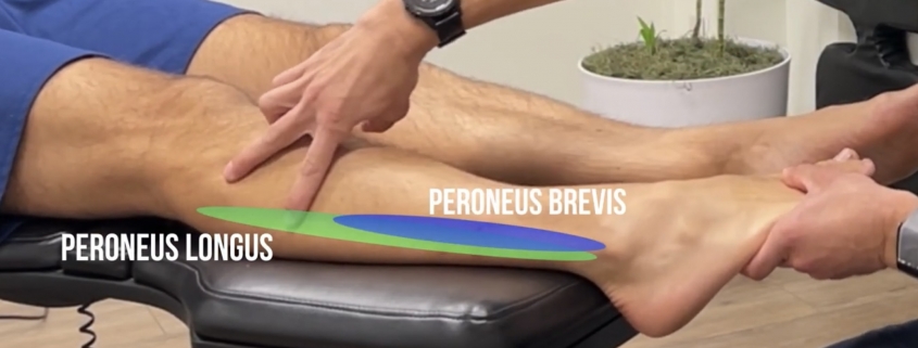 Peroneal tendonitis treatment san diego