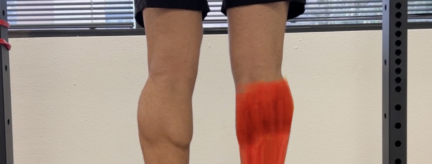 Achilles Tendinitis Treatment San Diego